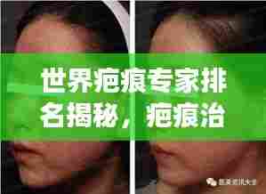 世界疤痕专家排名揭秘,疤痕治疗领域的最新进展与顶尖专家解读