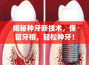 揭秘种牙新技术,保留牙根,轻松种牙!